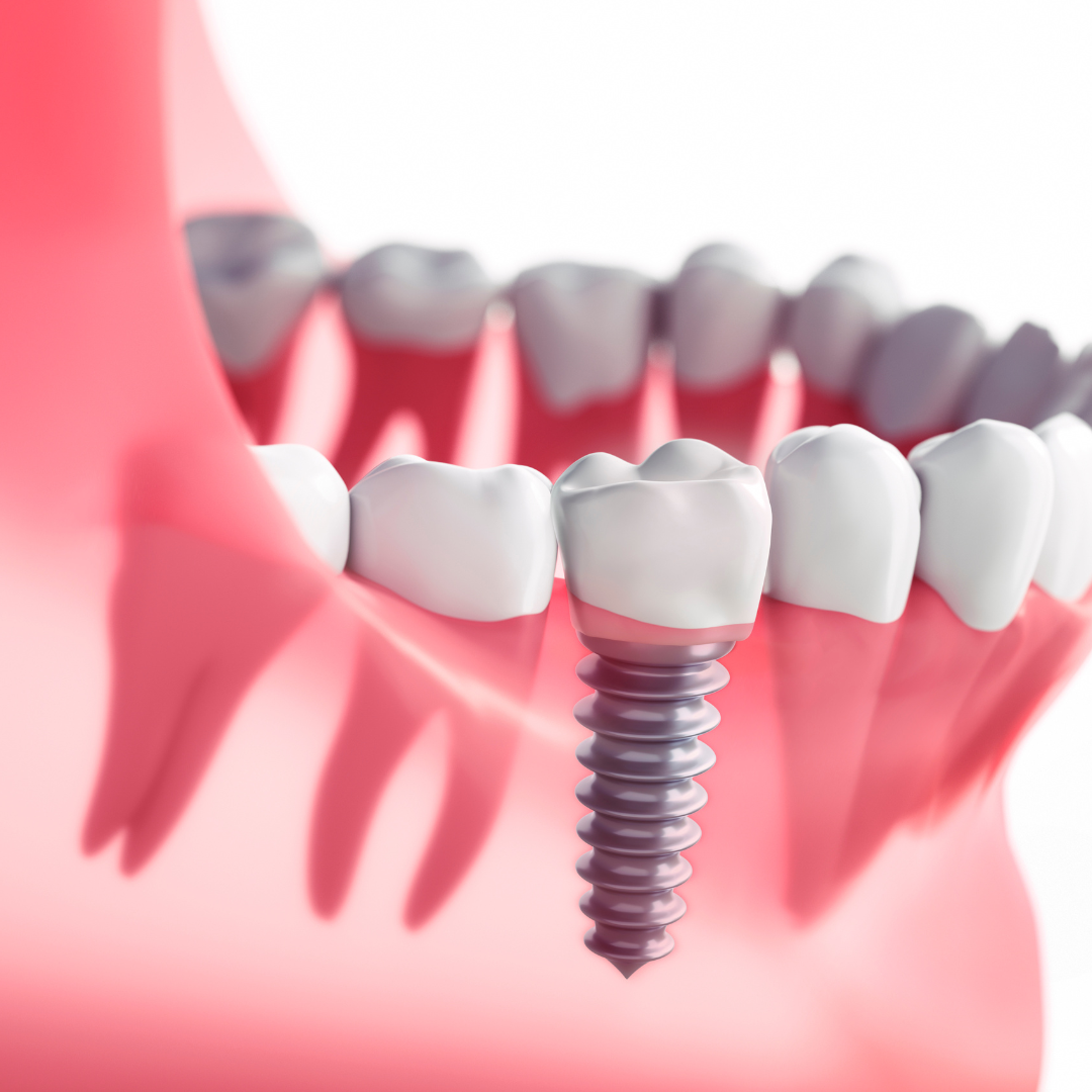 Why Is Mahimaa Dental The Best Dental Clinic In Coimbatore?